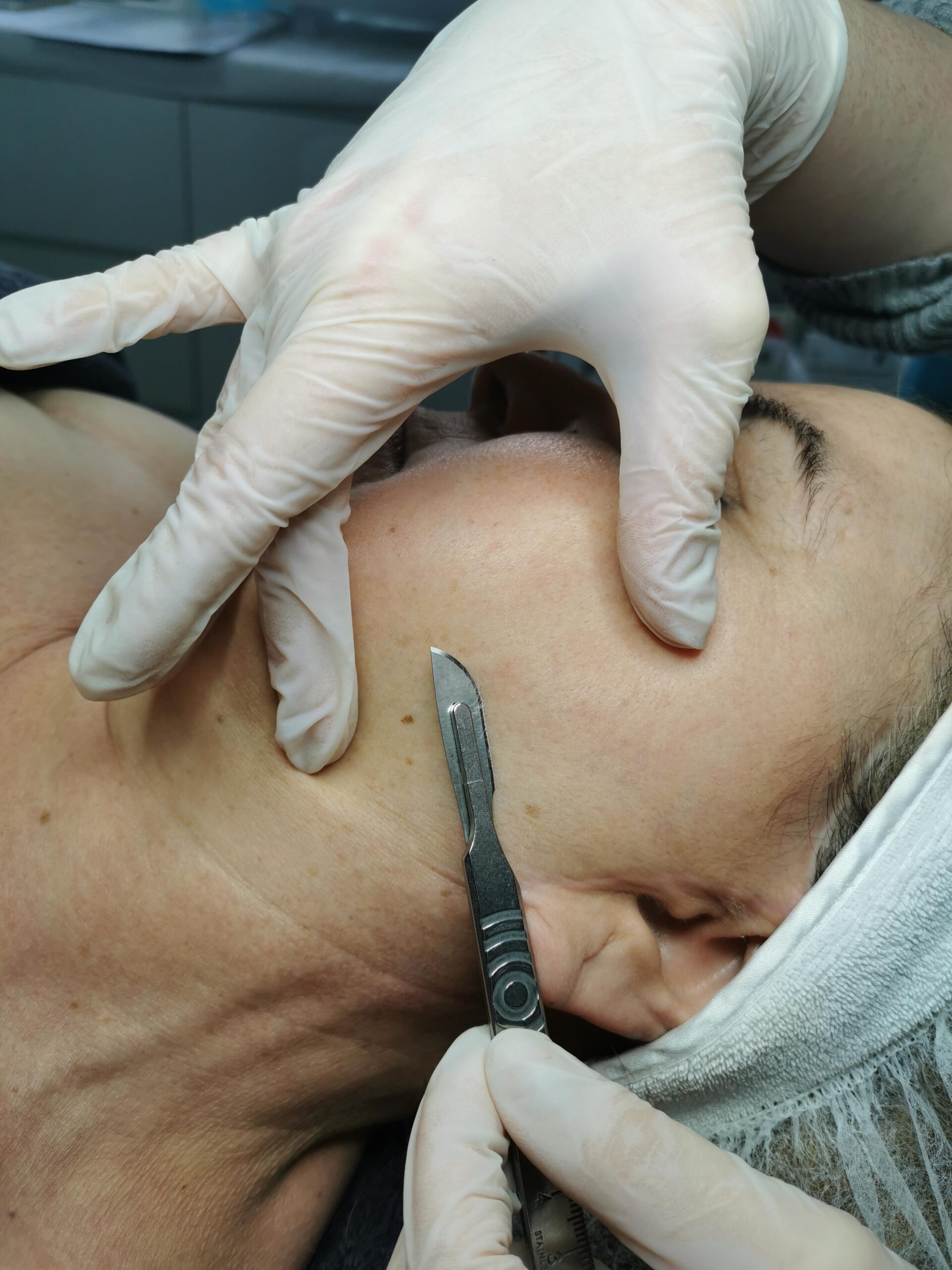 Dermaplaning