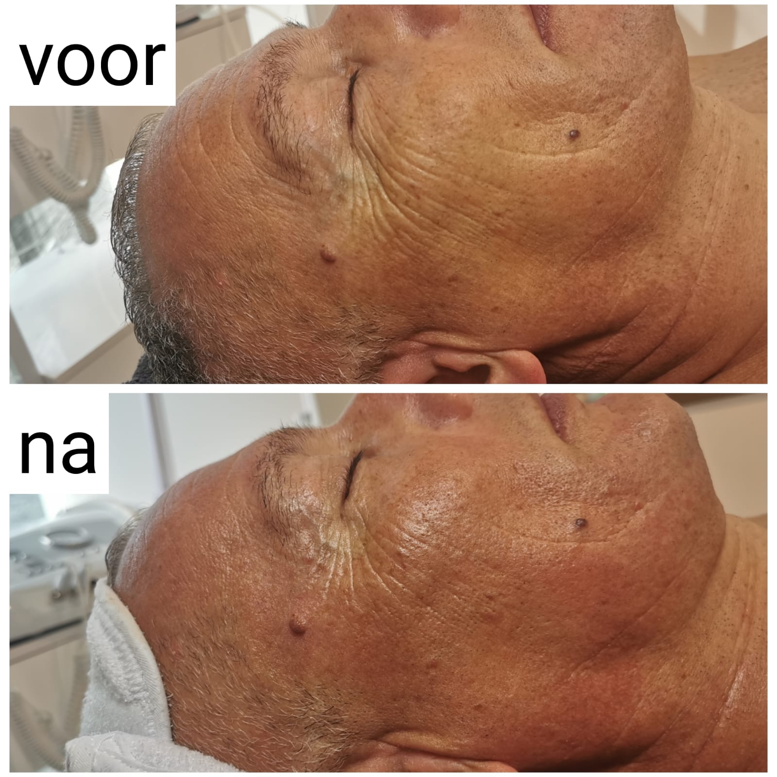 Bindweefsel massage