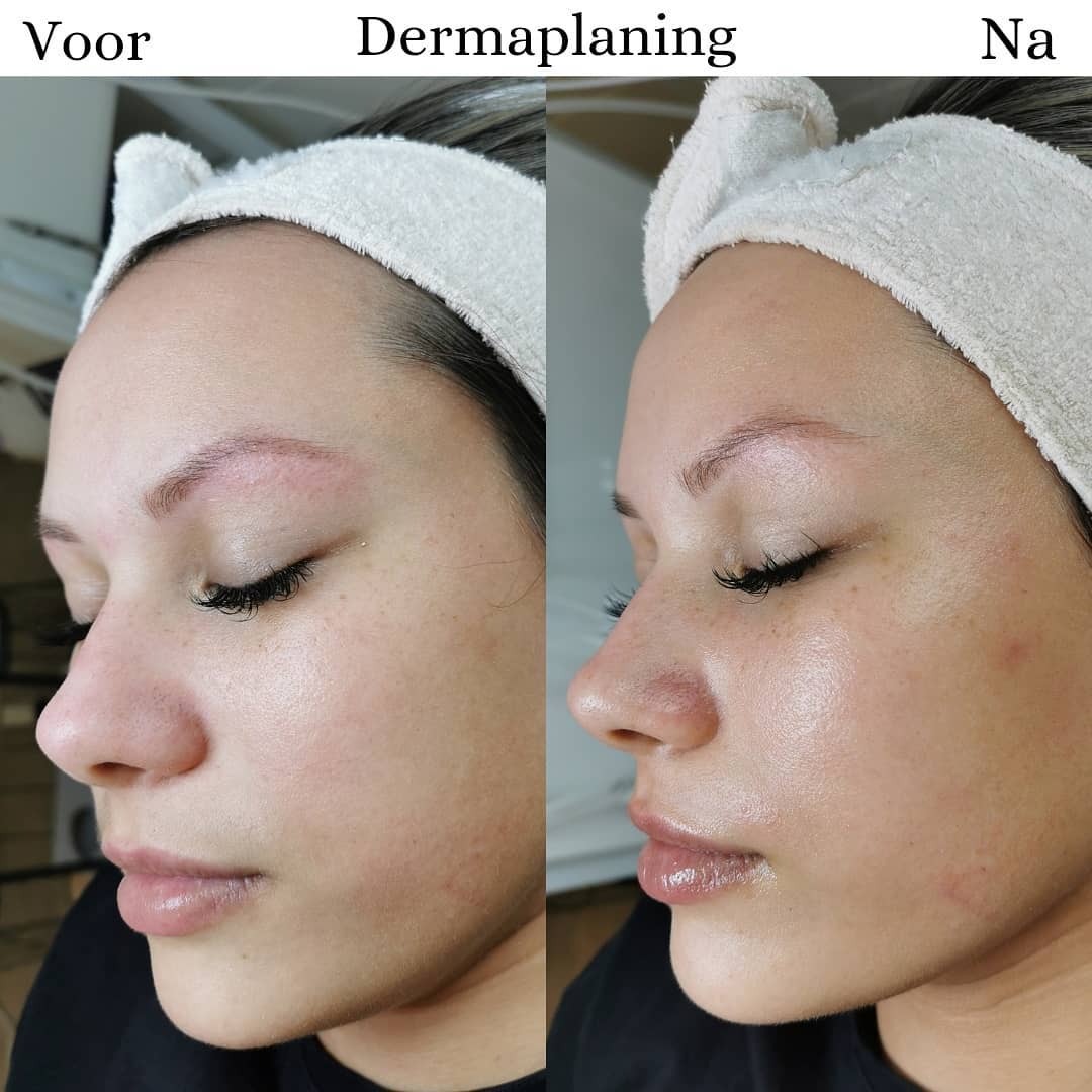 Dermaplaning