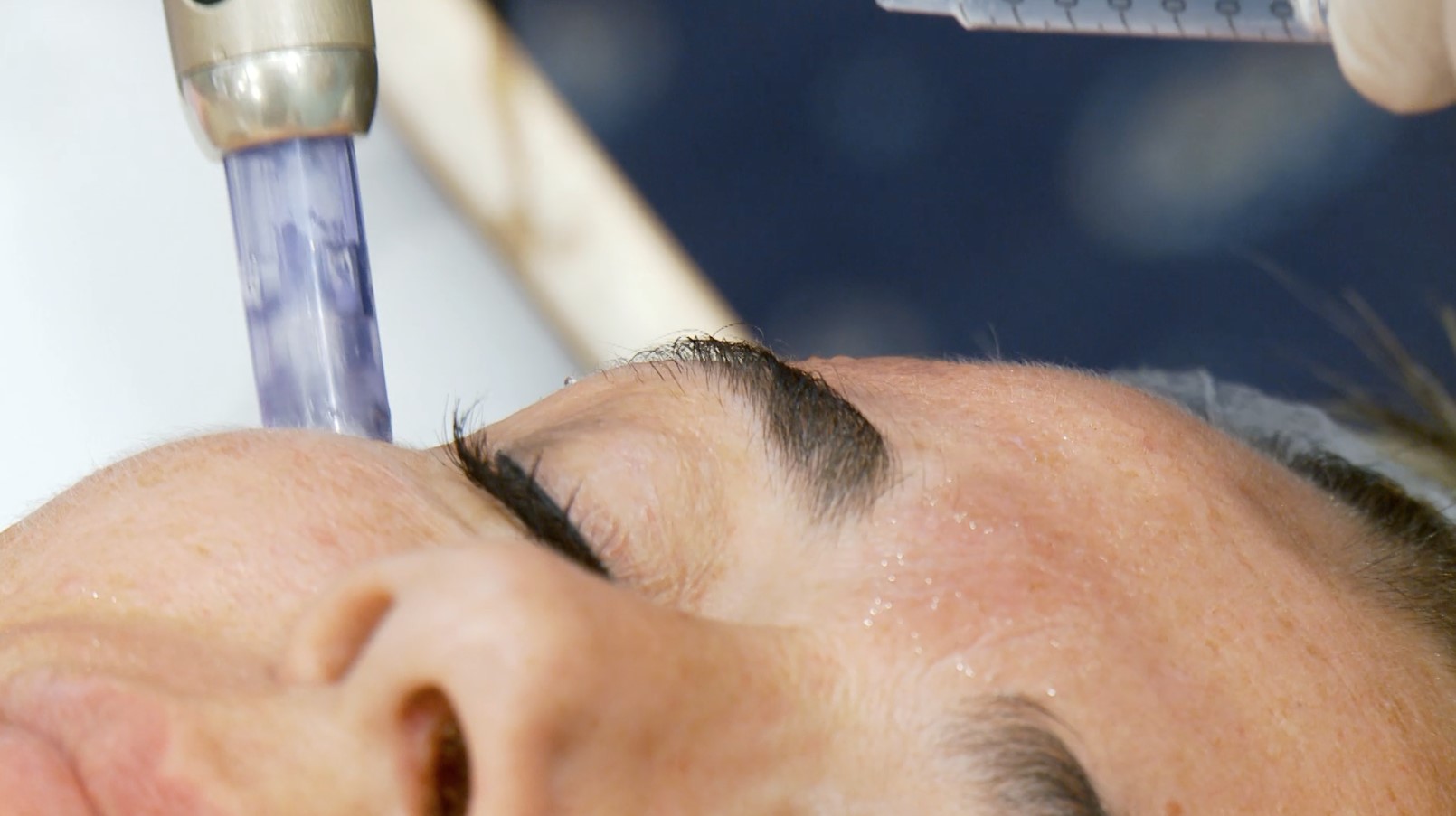 microneedling behandeling in nieuwegein